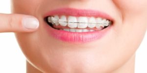 dental braces for adults
